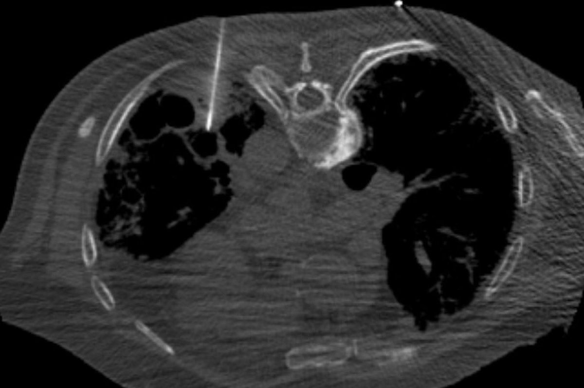 Joe Mammarappallil (@jmammarappallil) on Twitter photo Primary 🫁 Cancer in pts w/ Pulmonary Fibrosis is hard to treat. Excited to use <a href="/galvanizetx/">Galvanize Therapeutics, Inc.</a> #Aliya #PEF for treatment. Excited to see where this tech takes us in treating these patients. ♥️ the safety profile of the device. <a href="/DukeRadiology/">Duke Radiology</a> <a href="/DukeIR/">Duke IR</a> <a href="/PFFORG/">Pulmonary Fibrosis Foundation</a> <a href="/SIRspecialists/">Society of Interventional Radiology</a> <a href="/SIRRFS/">SIR RFS</a> Primary 🫁 Cancer in pts w/ Pulmonary Fibrosis is hard to treat. Excited to use <a href="/galvanizetx/">Galvanize Therapeutics, Inc.</a> #Aliya #PEF for treatment. Excited to see where this tech takes us in treating these patients. ♥️ the safety profile of the device. <a href="/DukeRadiology/">Duke Radiology</a> <a href="/DukeIR/">Duke IR</a> <a href="/PFFORG/">Pulmonary Fibrosis Foundation</a> <a href="/SIRspecialists/">Society of Interventional Radiology</a> <a href="/SIRRFS/">SIR RFS</a>