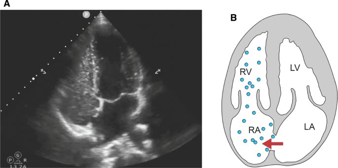 What is the purpose of bubble study in echocardiography⁉️

A- to increase blood flow velocities 
B- to visualise intracardiac shunt
C- to assess myocardial perfusion 
D- to enhance intracadial boarder delineation