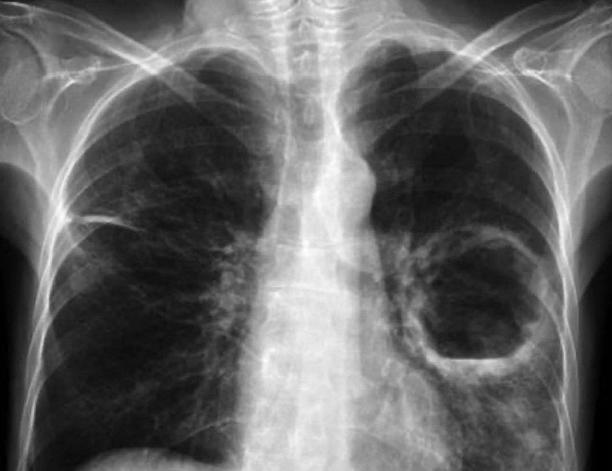 Patient presents with fever, cough, shortness of breath and fatigue.
Chest x-ray showed this.
What is your diagnosis?

#MedEd 
#MEDHM 
#MedX 
@IhabFathiSulima