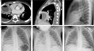Lurie IR challenging the established paradigm Percutaneous Drainage of Pediatric Pulmonary Abscesses: An Effective T... sciencedirect.com/science/articl… @socpedsir @LurieRad @jpedsurg @CVIR_Journal @SIRspecialists