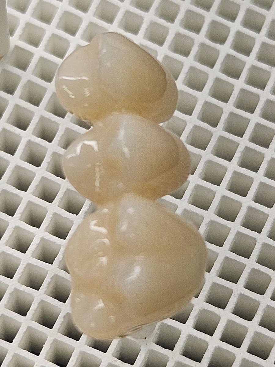 First case with a CAD/CAM
Bridge all-ceramic #24 #25 #26