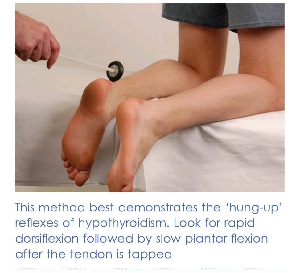 Method for testing ankle reflex in hypothyroidism for eliciting delayed relaxation phase. What is the name of the sign❓️ #MedTwitter #MedEd #MedX