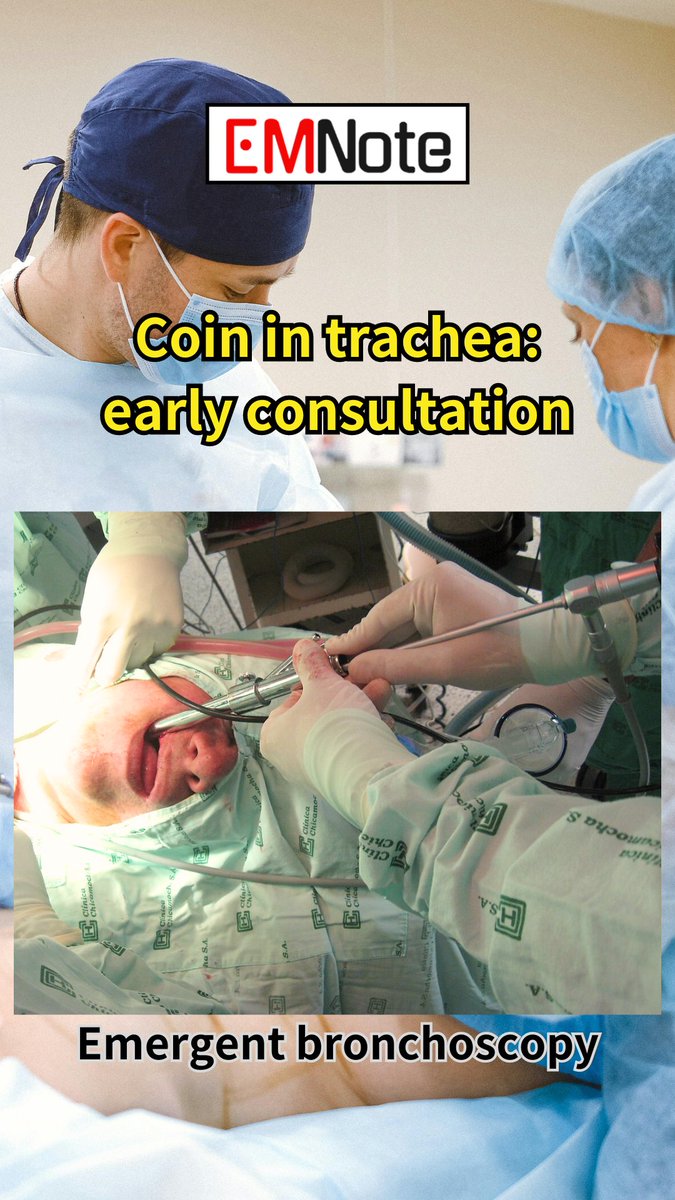 Coin in Trachea. youtube.com/shorts/fp8pOHK… Coins in the trachea are oriented sagittally and appear tangential on frontal radiographs and en face on lateral radiographs. Emergent bronchoscopy is the primary management strategy for airway foreign body obstruction.