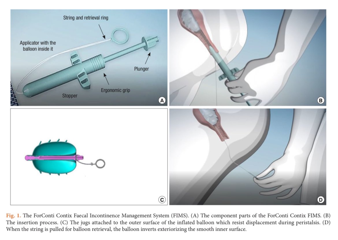 Clinical outcomes with of the Contix Faecal Incontinence Management System: preliminary results
DOI: doi.org/10.3393/ac.202…
#FecalIncontinence, #AnalPlug, #ForContiContix