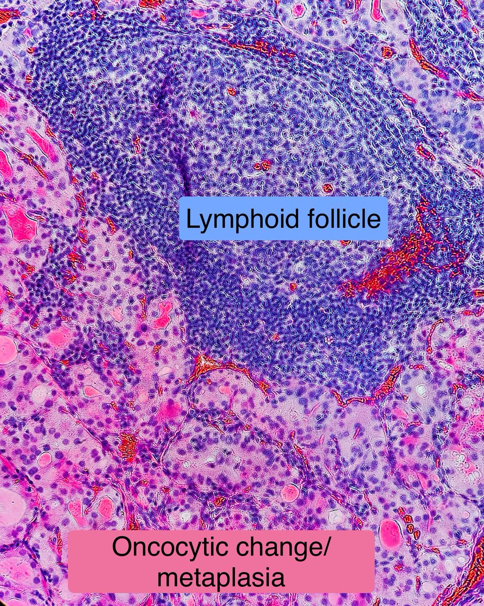 Hashimoto Thyroiditis

• #1 cause of hypothyroidism in iodine sufficient regions
• 🔬 lymphoplasmacytic infiltration, follicles w germinal centers, oncocytes, fibrosis
• Increased risk of primary thyroid lymphoma and papillary thyroid carcinoma

#pathagonia #pathx #medstudent