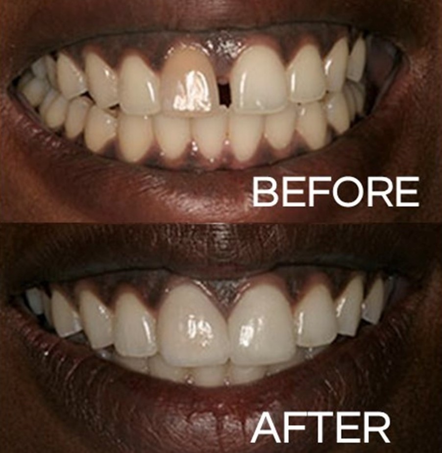 The before photo is of a patient who wanted a quick solution to close her diastema. The after photo was achieved with the installation of veneers to her central incisors.

#flossdental #thetoothdr #flossboss #beforeandafter #nachalooman  #repost #oralhygiene #trinidadandtobago