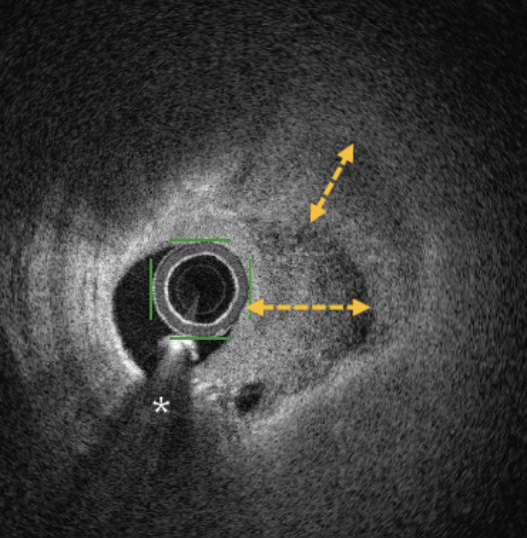 Which de novo lesions are more likely to benefit from drug-coated balloon angioplasty? Layered coronary plaques, like the one depicted in the figure. They can be recognized in optical frequency domain imaging by their heterogeneous tissue layers with different optical densities