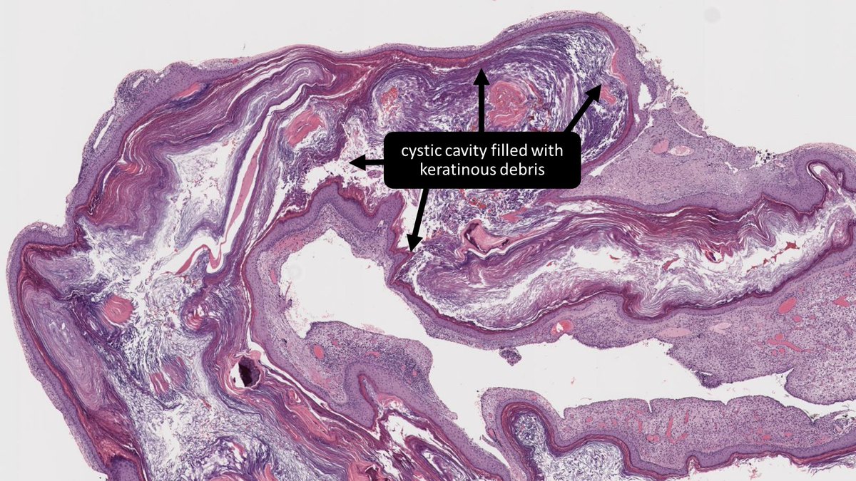 Which of the following is an essential component of cholesteatoma?
A) keratin debris
B) inflammed stroma
C) keratinizing epithelium
D) all of the above
#pathresidents #pathtwitter #bstpath #entpath #headandneckpath #pedipath
🔬tumourclassification.iarc.who.int/Viewer/Index2?…