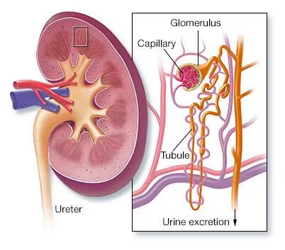 vipintukur's tweet image. A New Reliable Biomarker to track progression of Nephrotic Syndrome 

➡️ A new study could have a significant impact on the diagnosis and management of nephrotic syndromes, with results suggesting circulating #antinephrin autoantibodies could help predict disease activity. 1/