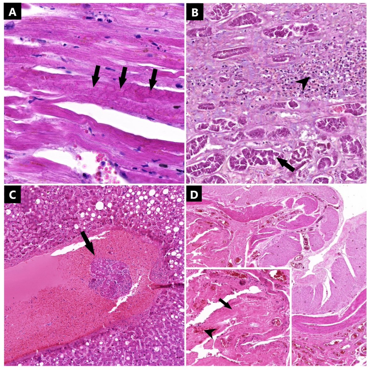 A new study analysed SARS-CoV-2 Viral Genome and Viral Nucleocapsid in 15 Covid19 patients who succumbed to their illness in Romania. The researchers found multi-system involvement of SARS-CoV-2 virus on autopsies. 1/