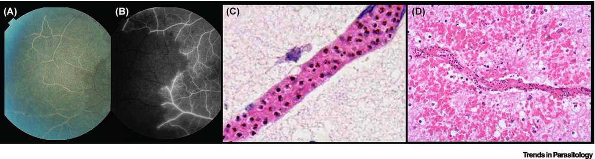 Trends in Parasitology (@trendsparasitol) on Twitter photo Dr. <a href="/ttmalawi/">Terrie Taylor</a> highlights a sequence of events linking decreased venous efflux to impaired perfusion, edema & neuroinflammation in a #murine #cerebral #malaria model by J. Goldschmidt, G. Nishanth & colleagues in a <a href="/NatureComms/">Nature Communications</a> article. <a href="/MSU_Osteopathic/">MSU College of Osteopathic Medicine</a>
authors.elsevier.com/a/1j9F95Eb1xJI… Dr. <a href="/ttmalawi/">Terrie Taylor</a> highlights a sequence of events linking decreased venous efflux to impaired perfusion, edema & neuroinflammation in a #murine #cerebral #malaria model by J. Goldschmidt, G. Nishanth & colleagues in a <a href="/NatureComms/">Nature Communications</a> article. <a href="/MSU_Osteopathic/">MSU College of Osteopathic Medicine</a>
authors.elsevier.com/a/1j9F95Eb1xJI…