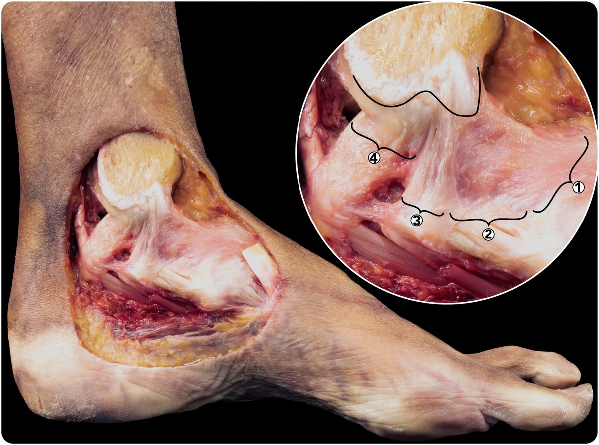 Just published🔥

The deltoid ligament is constantly formed by four fascicles reaching the navicular, spring ligament complex, calcaneus and talus

pubmed.ncbi.nlm.nih.gov/38757967/