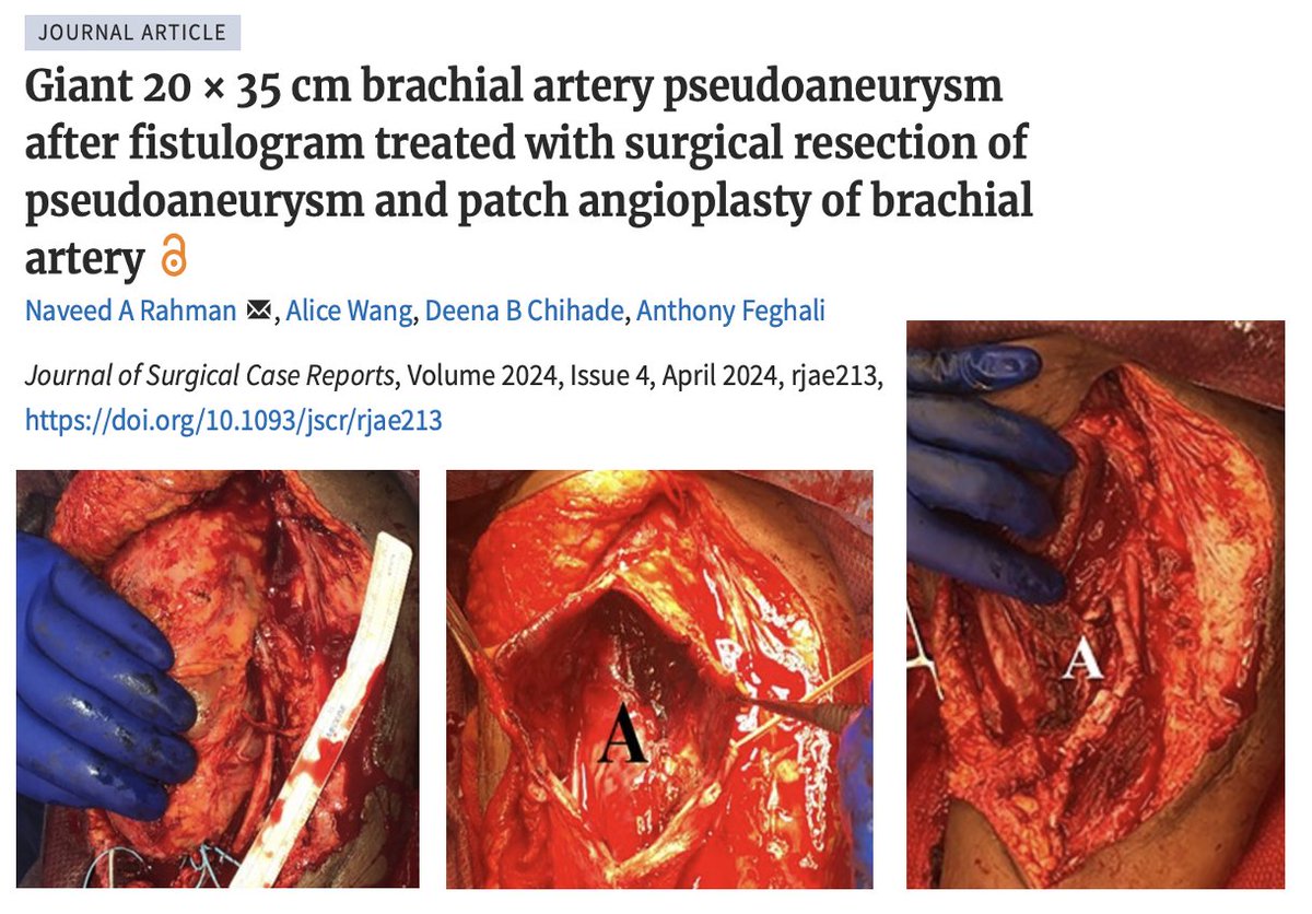 SUNY Upstate Division of Vascular Surgery (@upstatevascular) on Twitter photo Thank you <a href="/JSCR_Publishing/">Journal of Surgical Case Reports</a> for publishing this interesting case. Great job <a href="/naveedrahmanmd/">Naveed Rahman</a> <a href="/Agrace529/">Alice Wang</a> <a href="/HaroorandL/">HaroorandLulu</a> 🎉 Thank you <a href="/JSCR_Publishing/">Journal of Surgical Case Reports</a> for publishing this interesting case. Great job <a href="/naveedrahmanmd/">Naveed Rahman</a> <a href="/Agrace529/">Alice Wang</a> <a href="/HaroorandL/">HaroorandLulu</a> 🎉