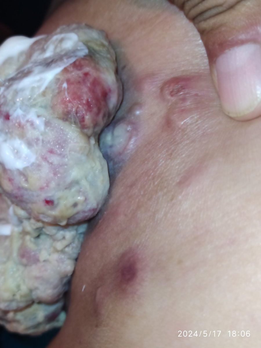 decofiestasyari's tweet photo. 🆘Lamentablemente el tumor volvió a sangrar 😢💔 Por favor #Ayuda para ponerme Quimioterapia. Urgente. Faltan $280. 0102 04249014646 10302119 https://t.co/bkkxd5Daqq GRACIAS 🫂 https://t.co/F0LjImEYiV