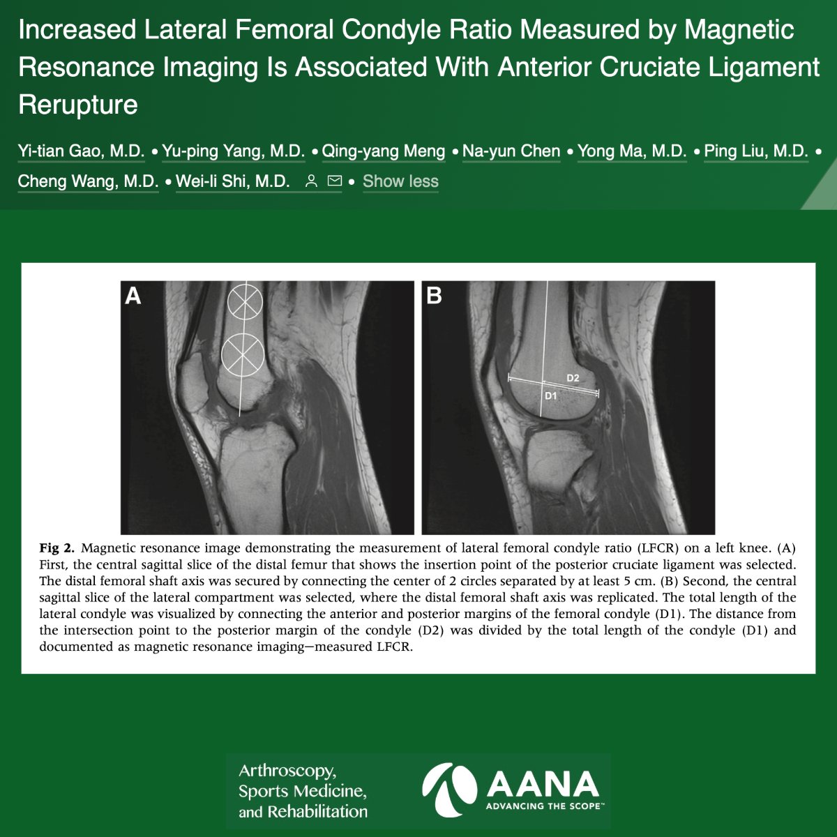Gao et al reported that MRI-measured lateral femoral condyle ratio was associated with ACL rerupture after anatomic ACL reconstruction . #ACLInjury #MRI #ACLReconstruction