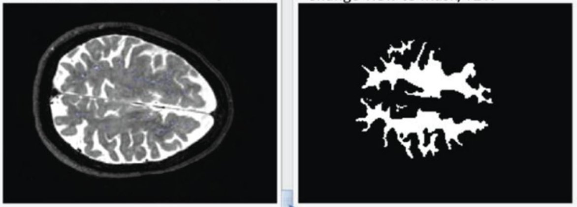 Journal of Huntington's Disease tweet media