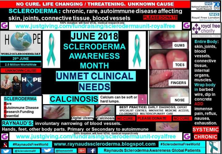 June #SclerodermaAwarenessMonth Unmet Clinical Need: Calcinosis: 
blog.raynaudsscleroderma.co.uk/2018/05/calcin… 
scleroderma #ClinicalTrials @RoyalFreeNHS: 
royalfreecharity.org/difference-we-… 
royalfreecharity.org/focus/sclerode…
royalfree.nhs.uk/services/scler…
#SclerodermaFreeWorld #RaynaudsFreeWorld 
#Research #SystemicSclerosis