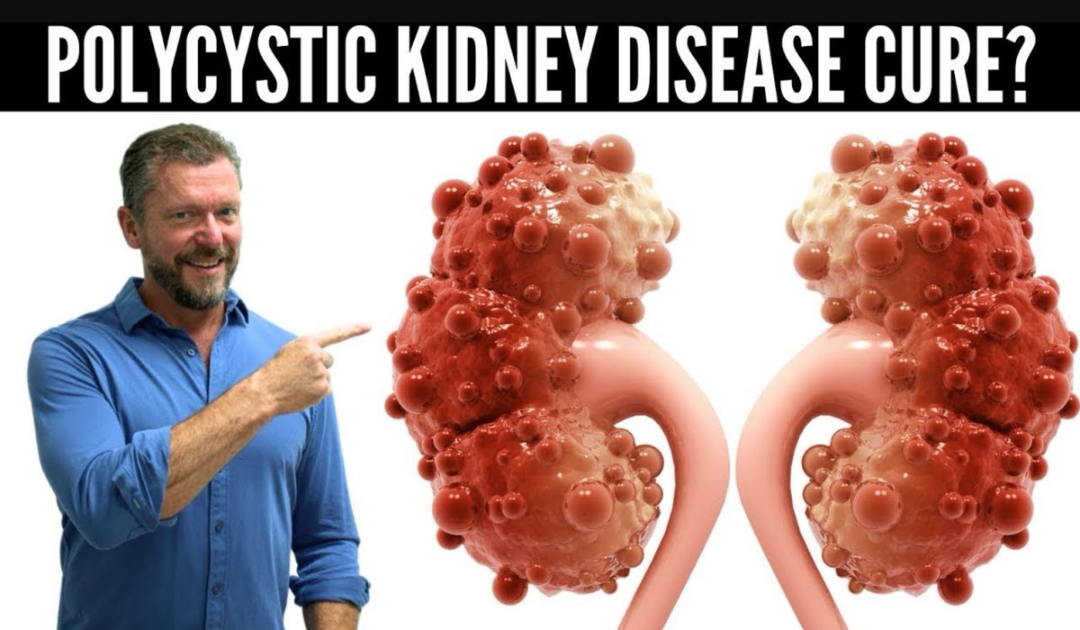 Every person with PKD needs to see this video! Polycystic Kidney Disease improves with KETO. Watch: youtu.be/jVTQVKc7fqM All the research proving what I say linked in the show notes, and there's a lot! Latest study: academic.oup.com/ndt/article/39…
