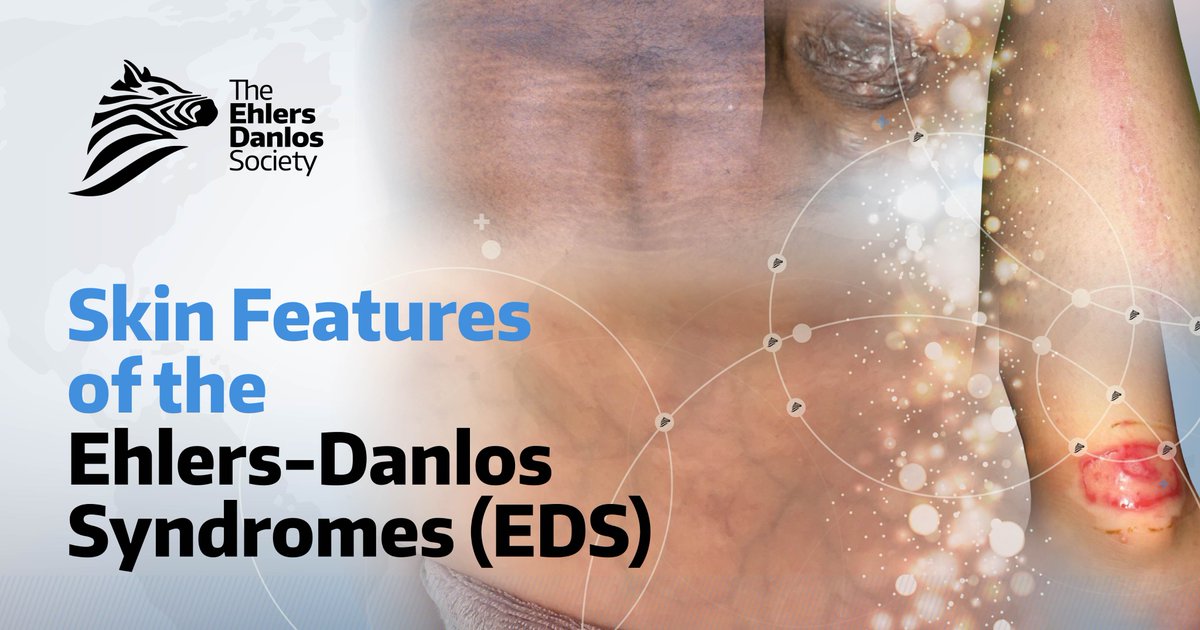 The Ehlers-Danlos syndromes (EDS) are a group of heritable connective tissue disorders. Connective tissue is found throughout the body and is an important component of the skin. Problems with connective tissue can cause changes in the skin. People with EDS may have skin