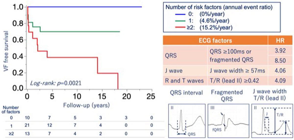 🔴Risk Stratification for the Occurrence of VF in Patients with Early Repolarization Syndrome ✅The occurrence of VF in pts w/ ERS assoc. with conduction abnormalities such as QRS widening, fQRS, high T/R ratio, positive LPs, & pilsicainide test results heartrhythmjournal.com/article/S1547-…