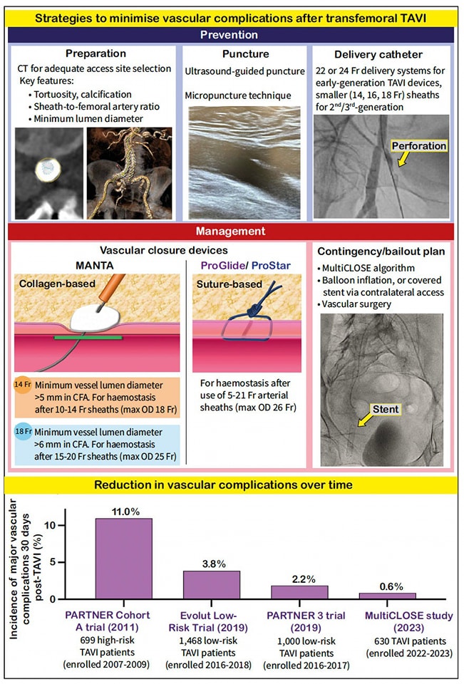 🔴 Strategies to minimise bleeding secondary to large-bore vascular access complications: an ounce of prevention is worth a pound of cure #editorial @EuroInterventio ✅eurointervention.pcronline.com/article/strate… #medtwitterWhat #MedTwitter #CardioEd #medx #medEd #CardioTwitter #cardiotwitter #MedX