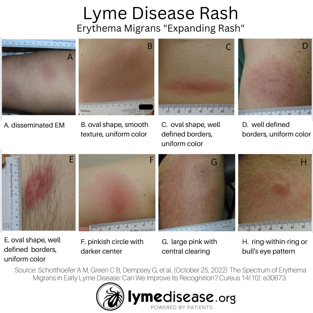 Sometimes, a Lyme-related rash is ignored because it doesn't look like a bull's eye. Meaning it's not a red ring-within-a-ring. A @LymeBiobank study of Lyme rashes found that only 6% of them looked like a bull's eye.
READ MORE lymedisease.org/lyme-rash-not-… #LymeDiseaseAwarenessMonth