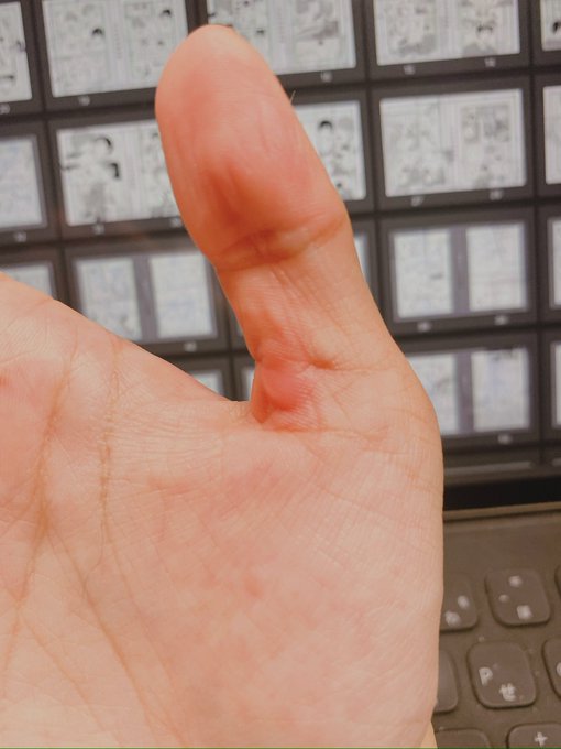 親指のタコがひどい https://t.co/QQXzZPS4lw