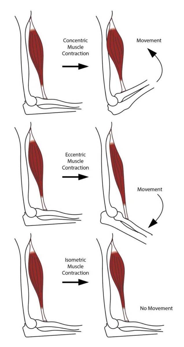 Omid_HopeUni's tweet photo. Categories of muscle contraction👇🏼

Concentric 👉🏾 shortening action of the muscle resulting in joint motion

Eccentric 👉🏾 lengthening action of the muscle to control movement against resistance

Isometric 👉🏾 constant muscle length without joint motion

https://t.co/EbOHGPl62y https://t.co/swSyO7zeAO