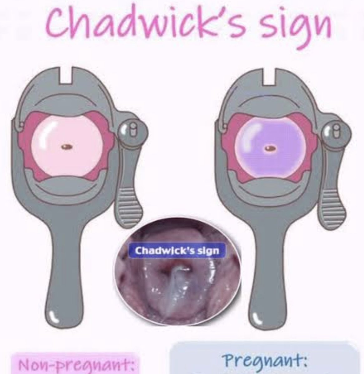 Chadwick's sign - bluish or purplish discoloration of vagina, labia and/or cervix in pregnancy via increased blood flow. May start at 6 - 8th wk of pregnancy (an early indicator of pregnancy)