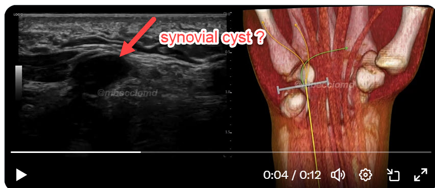 fatihcelikyay's tweet photo. @mbecciomd @michal_blaz is the arrow synovial cyst? https://t.co/mc5Ejh422k