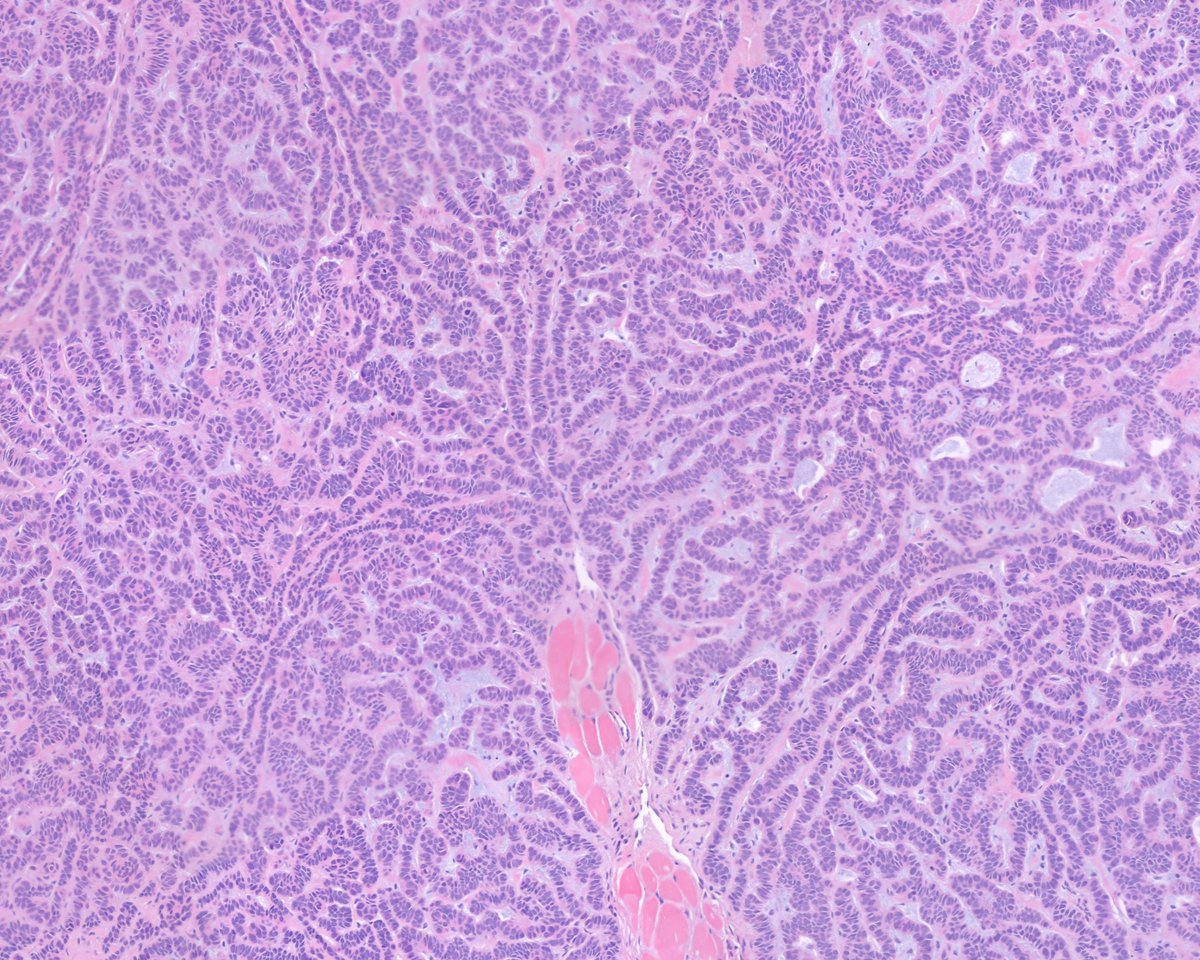 The mesmerizing labyrinthine wonderfulness of ripple pattern basal cell carcinoma