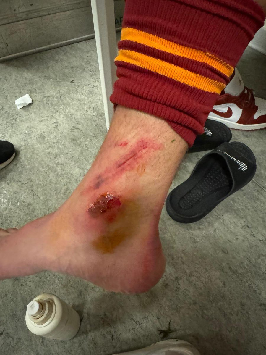 Hakemin ve VAR’ın penaltı vermediği pozisyonda Barış’ın bileği bu hale geldi ❗️