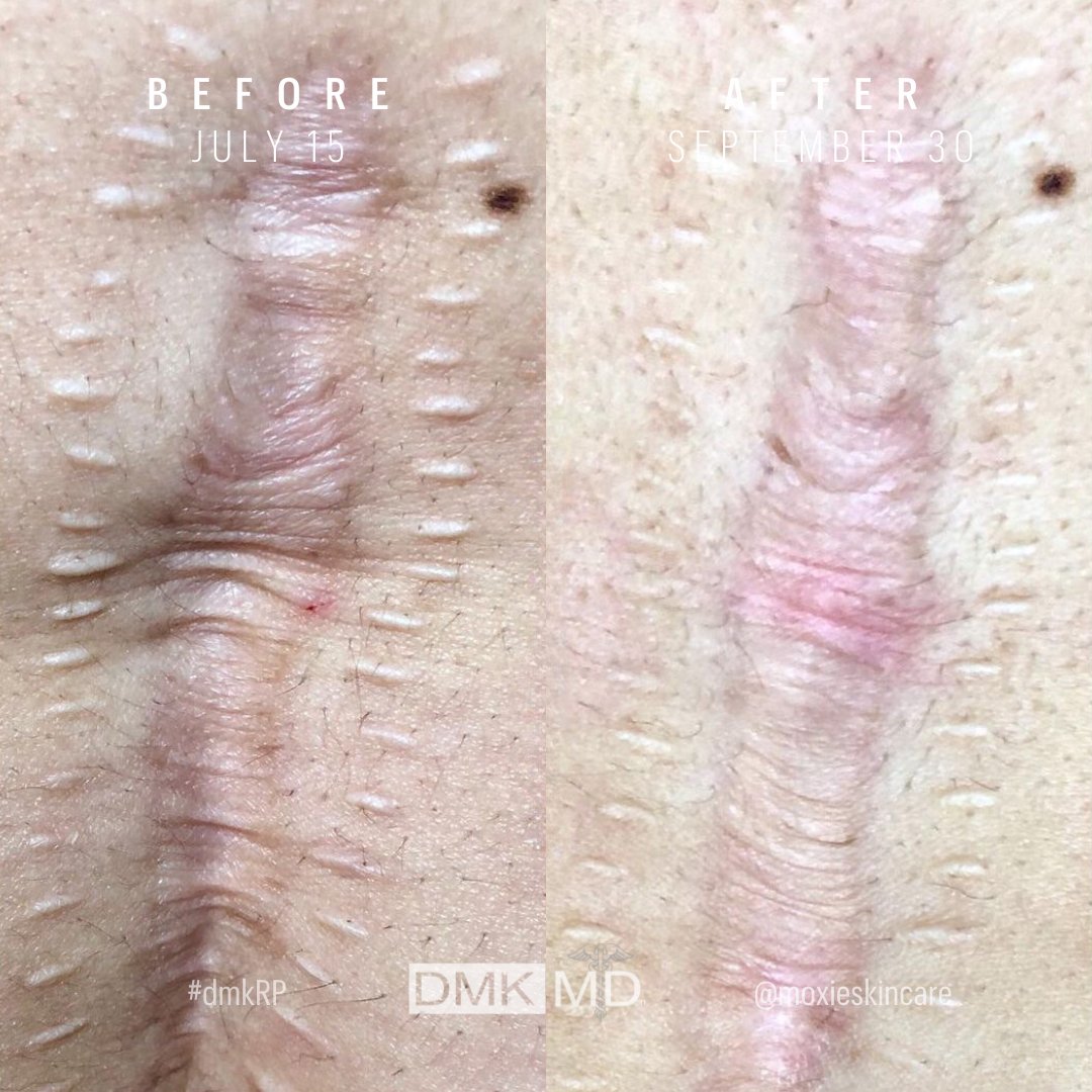 Masterful DMK Therapist @moxieskincare wows us yet again with this dramatic B&A showing scar revision and reduction! 💪💚

🥼 Get certified and use DMK’s revolutionary tools and treatments. Start today! 👉bit.ly/CertifyWithDMK

#DMKBodyEnzyme #TransformYourSkin #SkinRevision