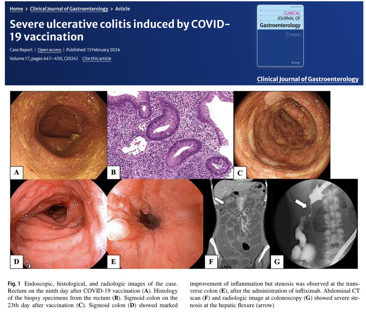 STUDY - @pfizer COVID-19 mRNA injections linked to severe ulcerative colitis.

The 37 year-old women began to experience nausea, abdominal pain, and severe diarrhea 12 hours after injection. The severe colitis was accompanied with diffuse mucosal erythema and ulcerations