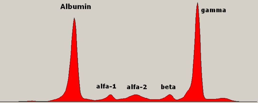 No Link Between Autoimmune Diseases and Monoclonal Gammopathy of Undetermined Significance 

Annals of Internal Medicine reports a study of more than 75,000 persons screened for  MGUS and found no association between AIRD and MGUS.

buff.ly/4buyuDu