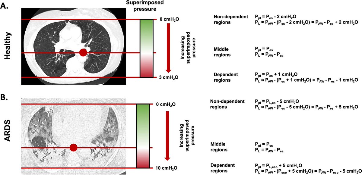 Transpulmonary pressure monitoring in critically ill patients: pros and cons

CCR Journal Watch
criticalcarereviews.com/latest-evidenc…

Get the latest critical care literature every weekend via the CCR Newsletter - subscribe at criticalcarereviews.com/newsletters/su…