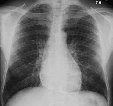 A 65 year old  with dyspnea, fatigue and ascites.
What's the most likely diagnosis?

#MedEd 
#MEDHM 
#MedX 
@IhabFathiSulima