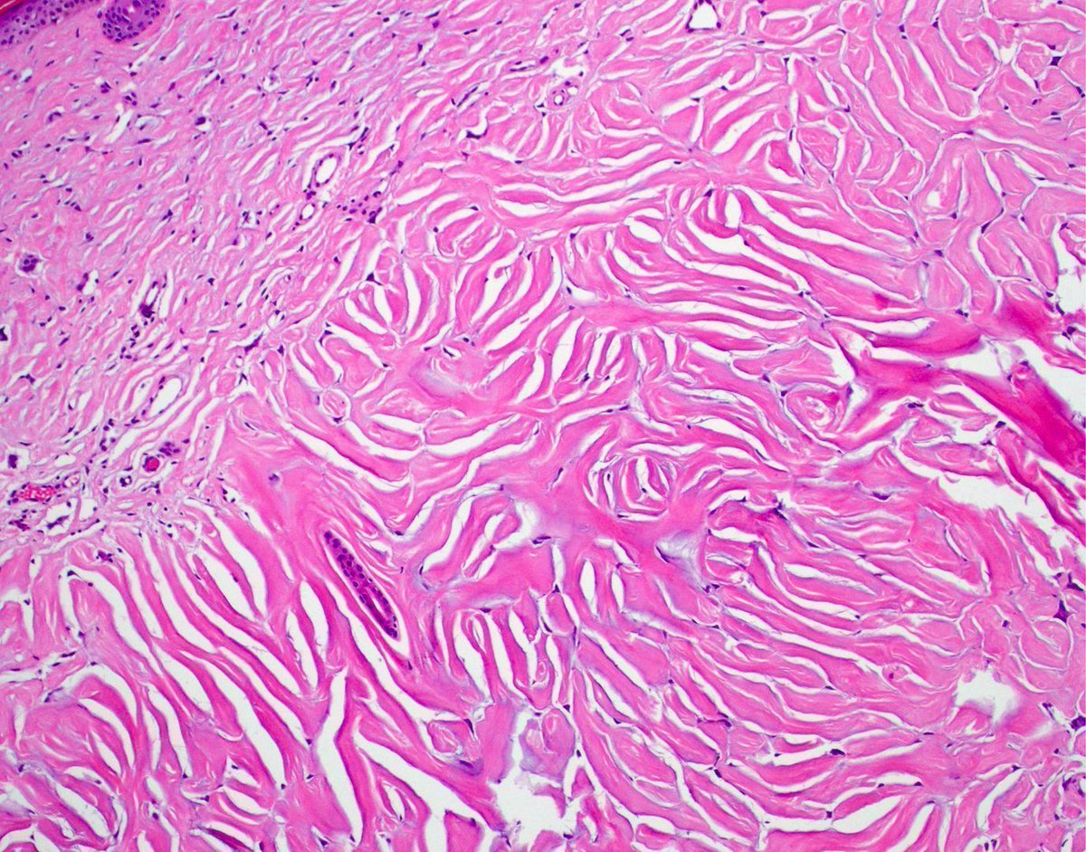 40 F. Neck papule.
More pics: kikoxp.com/posts/8210. 
Diagnosis: youtu.be/AAdC5Jqc3xQ?si… 
If multiple lesions were present, what might it indicate? 
Answer: kikoxp.com/posts/8208 
#pathology #pathTwitter #dermpath #dermatology #dermtwitter #BSTpath