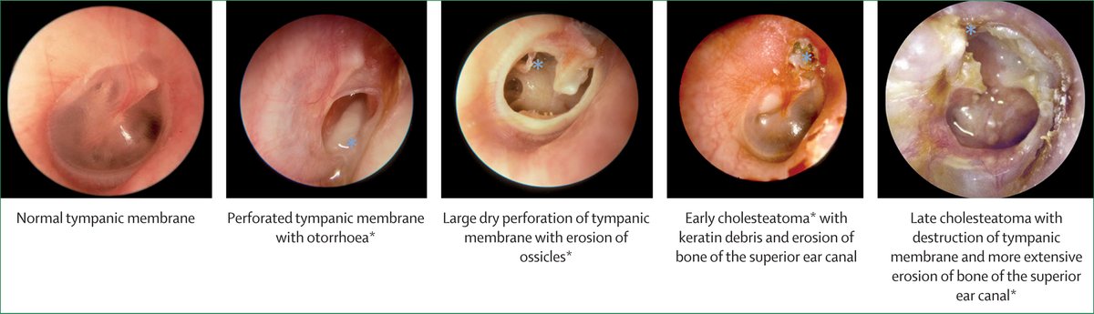 Chronic suppurative otitis media (CSOM) is a leading global cause of potentially preventable hearing loss in children and adults. In a Seminar, authors explore the current state of knowledge for diagnosis, management, and prevention of CSOM: hubs.li/Q02ypb150