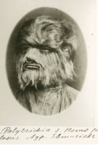 Not a werewolf. It’s picture of a patient suffering from polytrichia, or excessive hairiness. Photo Credit: National Library of Medicine