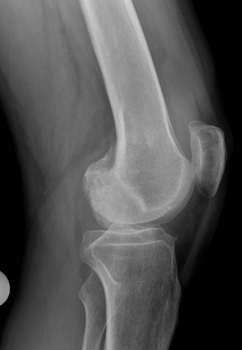 Middle aged patient with knee pain 

#radres #radtwitter
