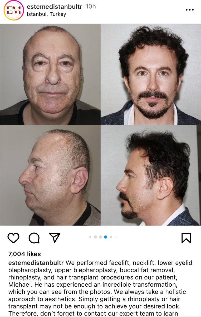 no Turkey surgeons are fucking wild with their 8 surgeries at once…..this man came back looking 30 years younger