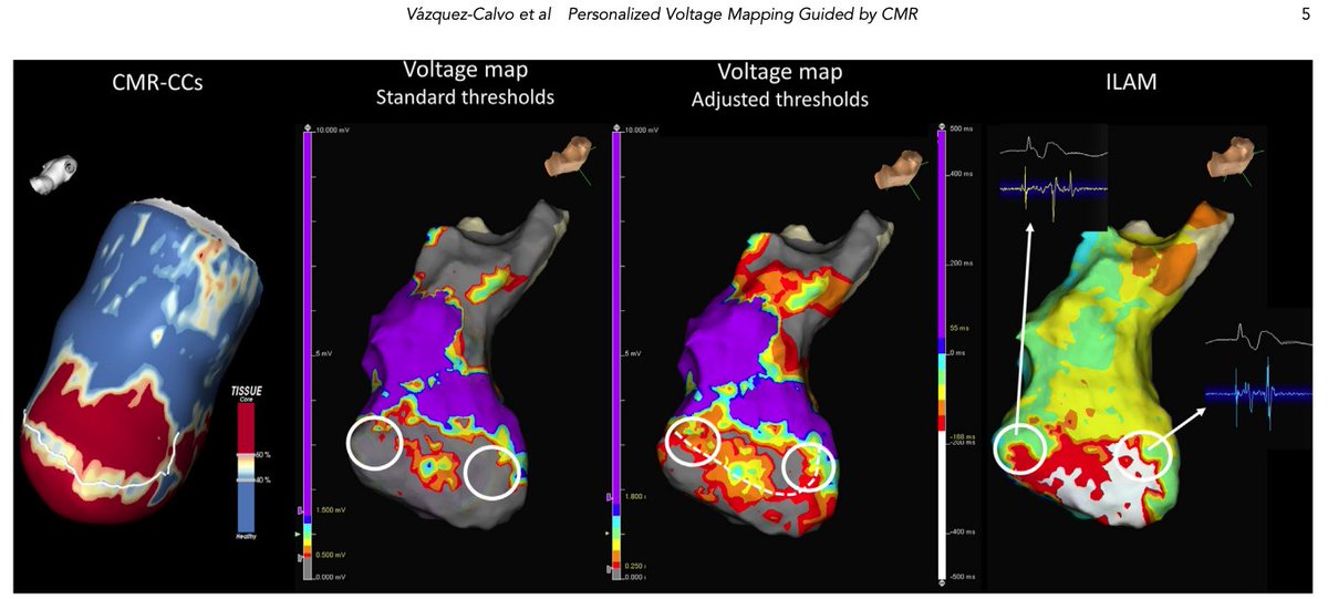 Lovely work led by @S_Vazquez_Calvo and @ivroca to improve the way we do bipolar voltage mapping for the #ablateVT substrate. Threshold personalization is the key! Probably it is time to forget the 0.5-1.5mV... #EPeeps @hrs_journal 
doi.org/10.1016/j.hrth…