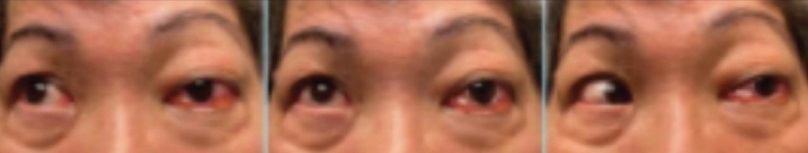 A 71yo woman presented after 7 days of left eye conjunctival injection & discomfort. She had upper & lower lid edema for 2 days and pressure behind the eye. She also had decreased visual acuity and intermittent diplopia. #Whatsthediagnosis #FOAMed tinyurl.com/5fsjrjmw