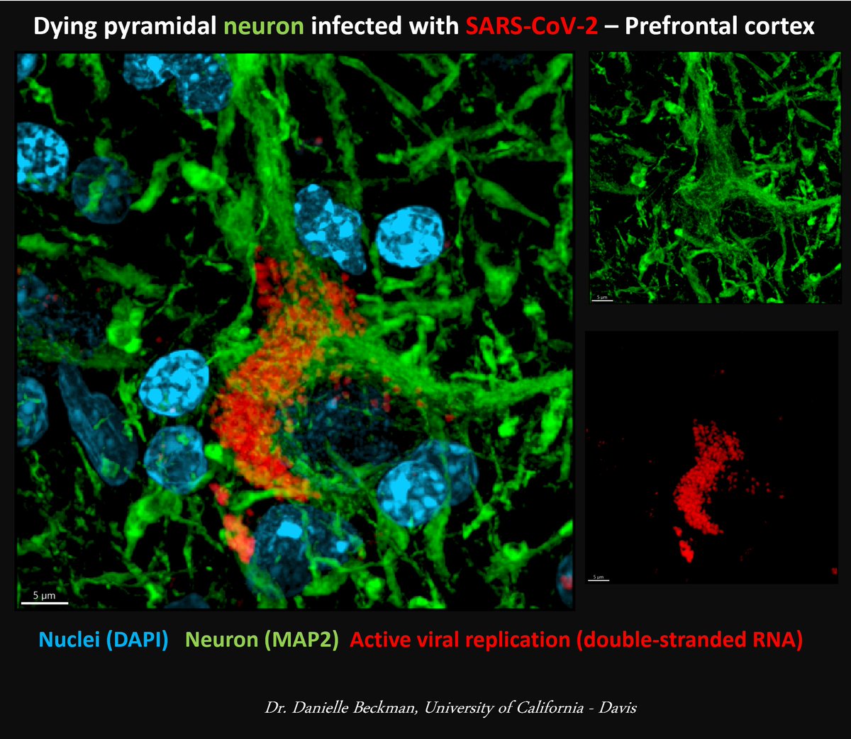 I apologize to everyone who used to follow me before, especially the ones here for microscopy photos. But I can't and won't stop talking about viruses. If you love neurons and brains like I do, and your job is to look at this daily, you would also be heartbroken. 🔬💔