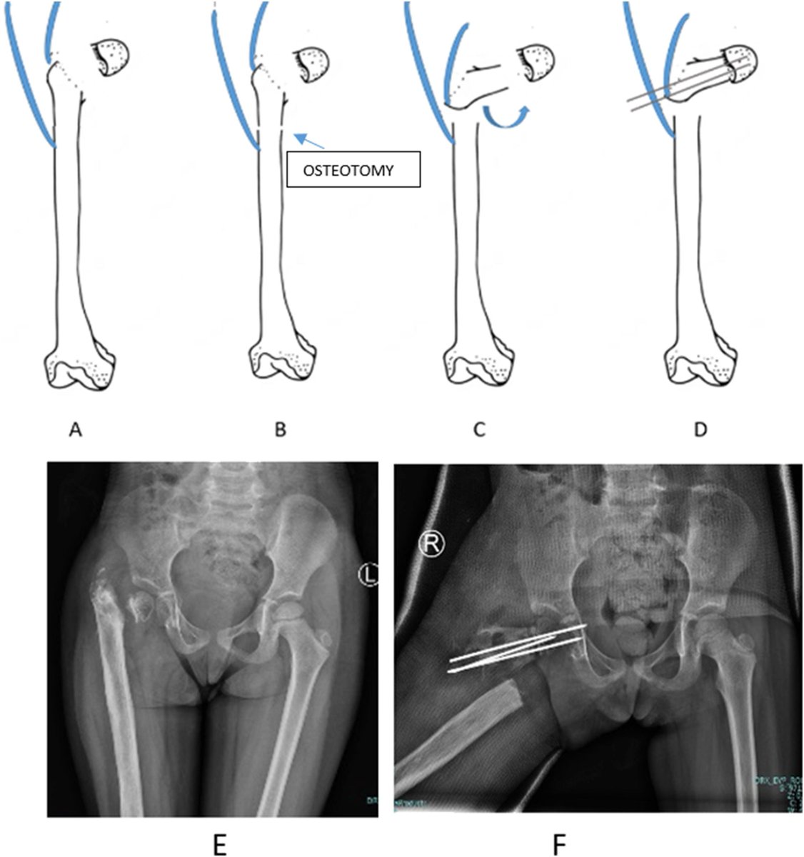 Modified “SUPERhip2” to Reconstruct Postinfectious Femoral Neck Pseudoarthrosis (Hunka Type 3) #hip bit.ly/3KcEWTp