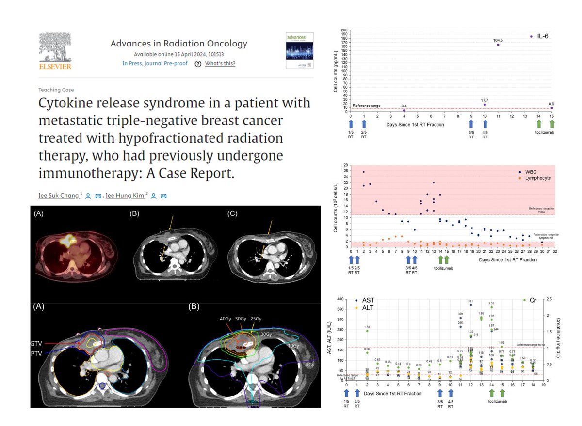 (1/2) 
🔥Check out our new case report on fatal cytokine release syndrome following palliative hypoFx RT in mTNBC patients who had previously undergone IO. 

Post-RT, ⬆️IL-6 and other inflammatory markers, accompanied by CRS Sx (fever, ⬇️O2, ⬇️BP). 
doi.org/10.1016/j.adro…