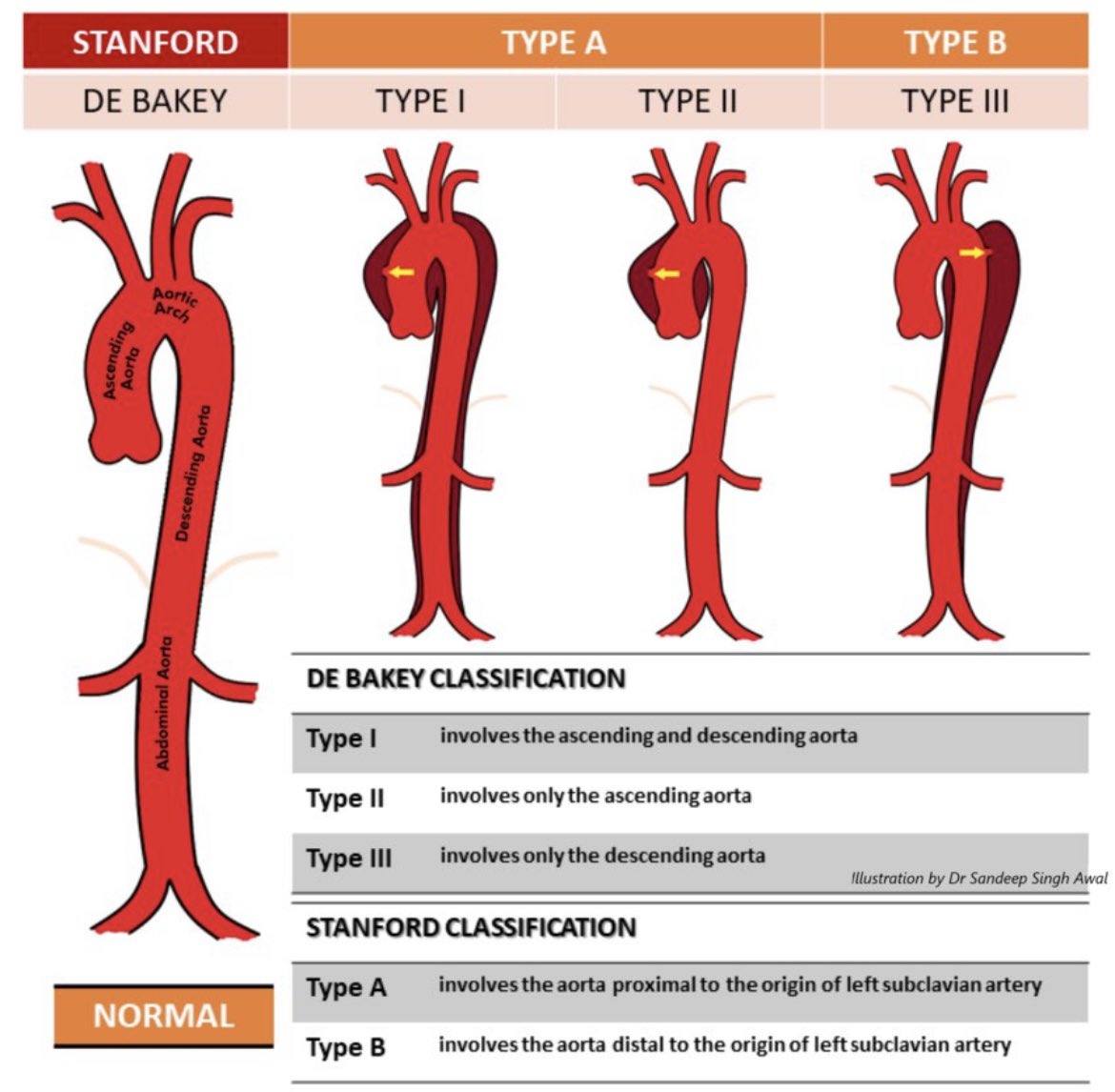 Aortic Dissection classifications 🫀 #FOAMed #MedEd #vascularED #CardioEd #CardioTwitter #MedTwitter #livertwitter #Cardiology #livertwitter #4KMedEd #ECG #medicalstudent #MedicalEducation #Emergency #medicalpractice #medx #cardiovascular