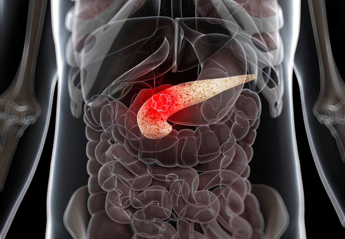 Usually when pancreatic cancer is first discovered, it is in an advanced stage resulting in a very poor prognosis. This may change that.

MicroRNAs May Predict Pancreatic Cancer Risk Years Before Diagnosis

medscape.com/viewarticle/mi…