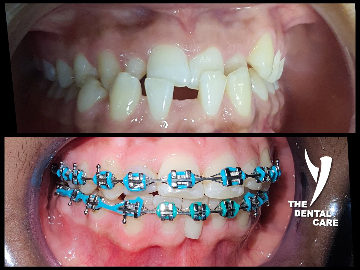 'Transform your smile with Braces! Straighten your teeth, improve oral health, and boost your confidence. Schedule your consultation today and start your journey to a perfect smile. #Orthodontics #DentalCare #SmileTransformation'sekodental.co.za 015 280 0142